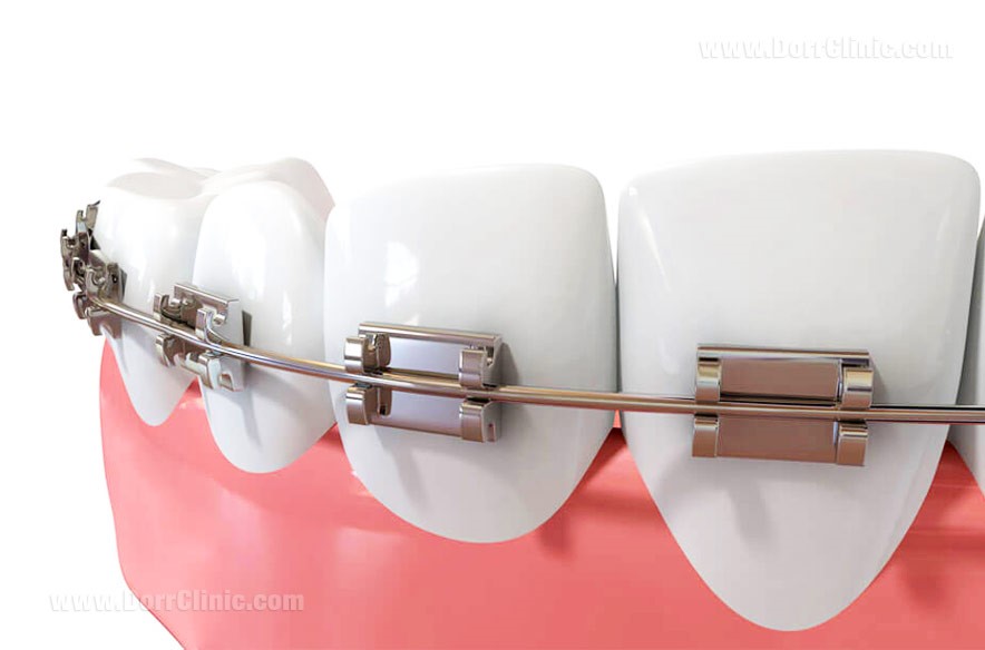 آیا ارتودنسی تنها یک دندان کج با هزینه کم ممکن است؟